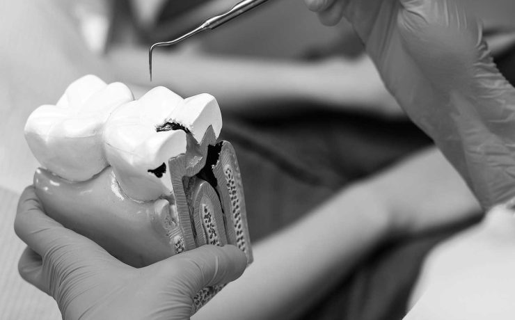 dentista con modelo que representa un diente con caries