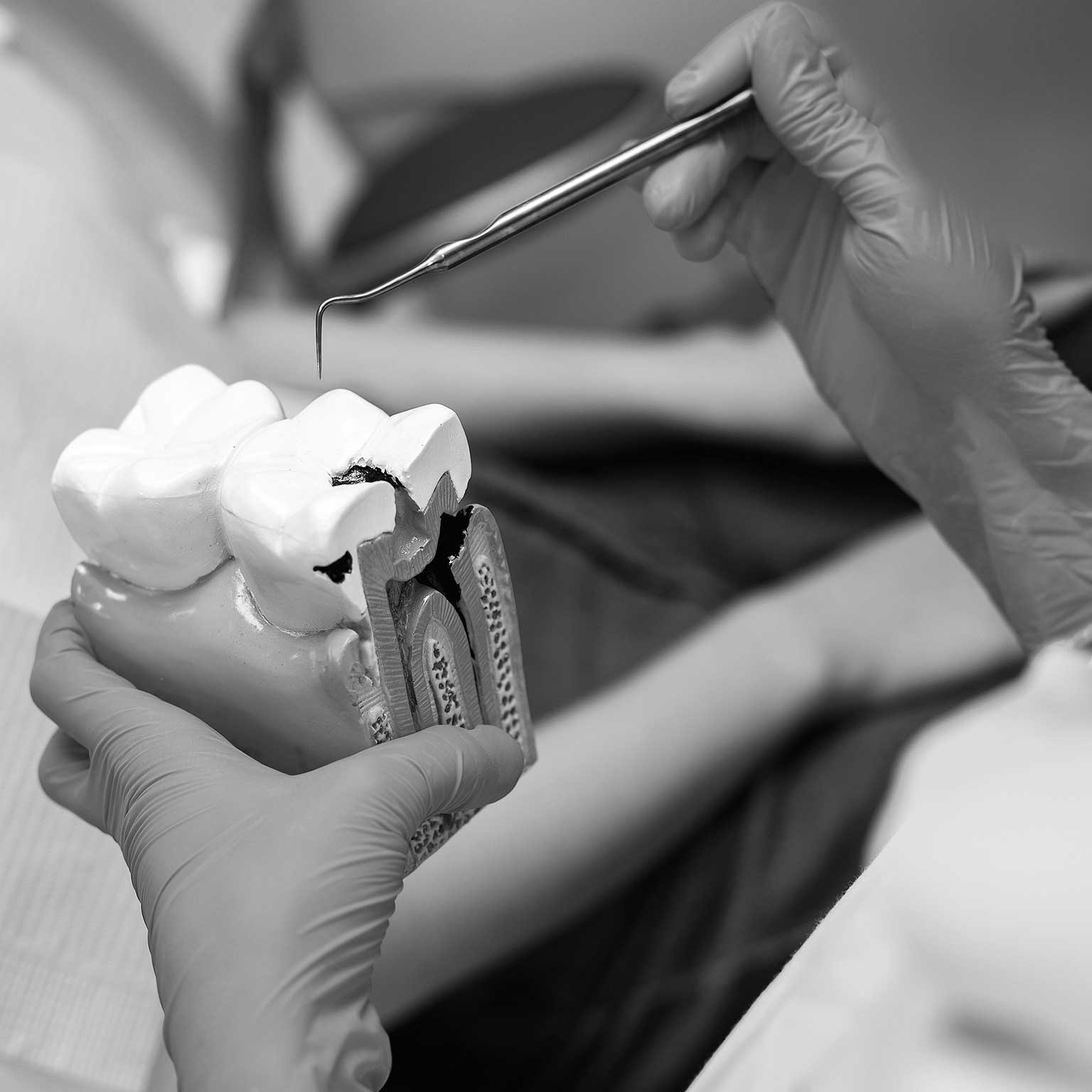 dentista con modelo que representa un diente con caries